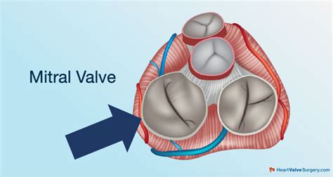 Mitral Valve Repair Different Approaches For Patients