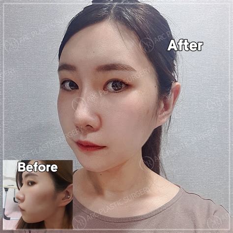 Facial Contouring Buccal Fat Removal Before And After