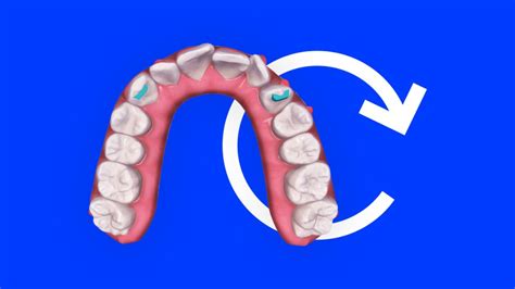 Managing Severe Rotations In Clear Aligner Therapy Invisalign