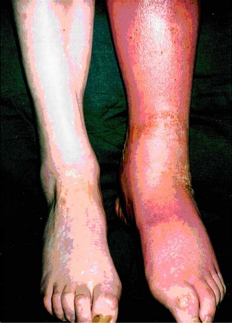 Figure 1 From Management Of Lower Leg Cellulitis Semantic Scholar