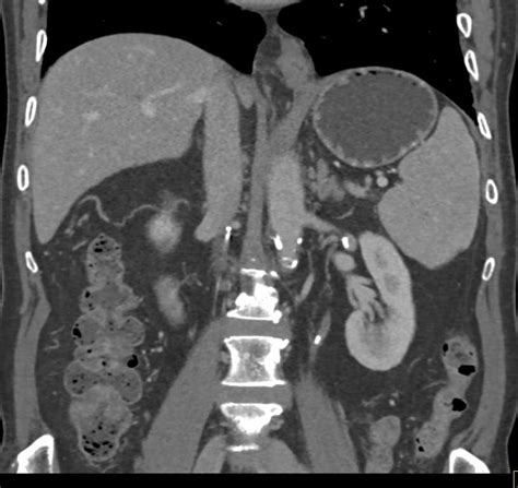 Hiatal Hernia Esophagus Case Studies Ctisus Ct Scanning