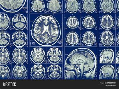 Brain Scan X-ray Mri Image & Photo (Free Trial) | Bigstock