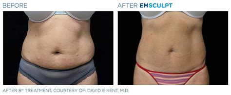 EMSCULPT RESULTS | SEE REAL PATIENT OUTCOMES