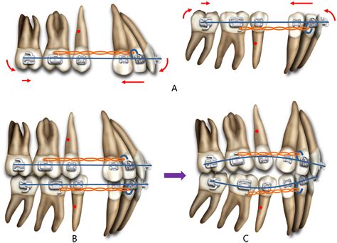 Recovery Of Anterior Torque Loss And Correction Of Deep Bite Occuring During Orthodontic