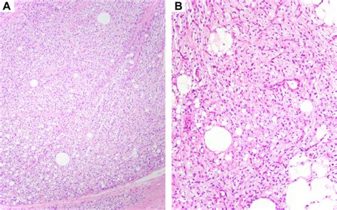 Expanding The Clinicopathologic And Molecular Spectrum Of Lipoblastoma