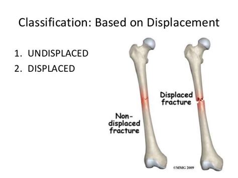 Classification of Fractures & Compound Fracture Managment