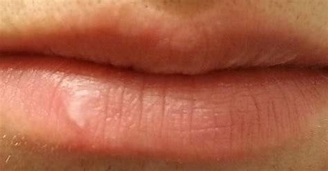 Skin Concern Have This Hard White Spot On My Lip That I Cant Seem To Get Rid Of I Bite My