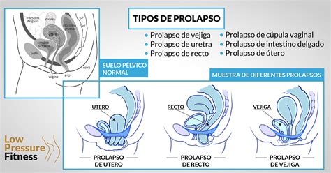 Las Claves Para El Tratamiento Conservador De Un Prolapso De Suelo