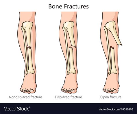 Types Of Bone Fractures Diagram Medical Science Vector Image