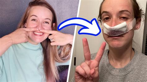 Deviated Septum Surgery Recovery Pictures