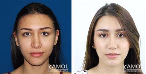 Cheekbone Reduction Zygoma Reduction Kamol Cosmetic Hospital