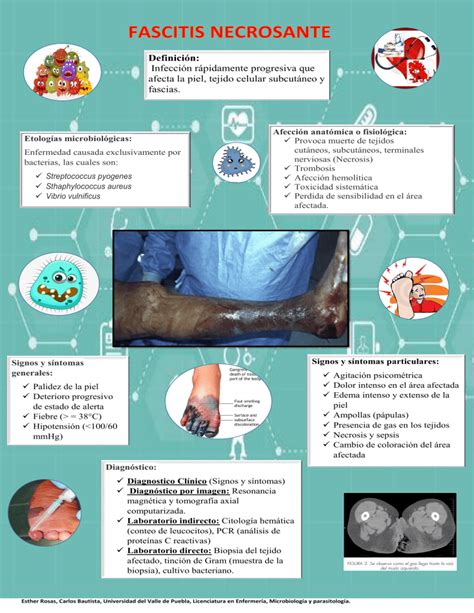 Infografia Fascitis Necrosante