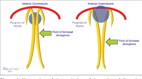 Figure 5 From Colloid Cysts Posterior And Anterior To The Foramen Of Monro Anatomical Features