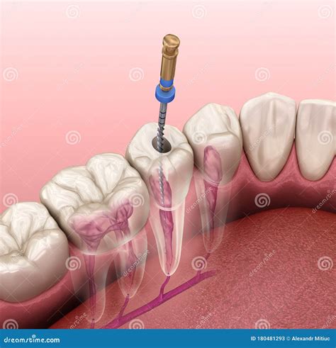 Endodontic Root Canal Treatment Process Medically Accurate Tooth