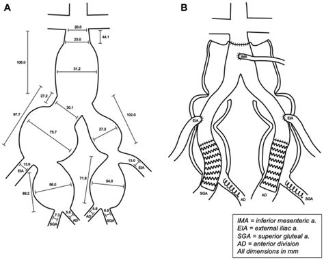 A Hybrid Approach To Complex Bilateral Common Iliac Artery And Internal Iliac Artery Aneurysm