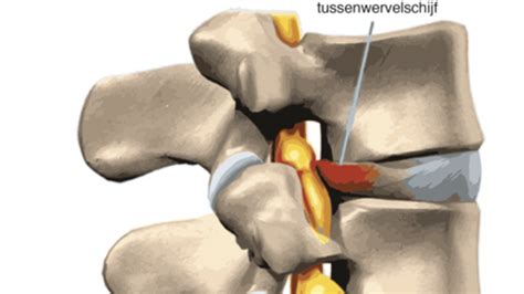 Wat Is Een Lumbale Hernia