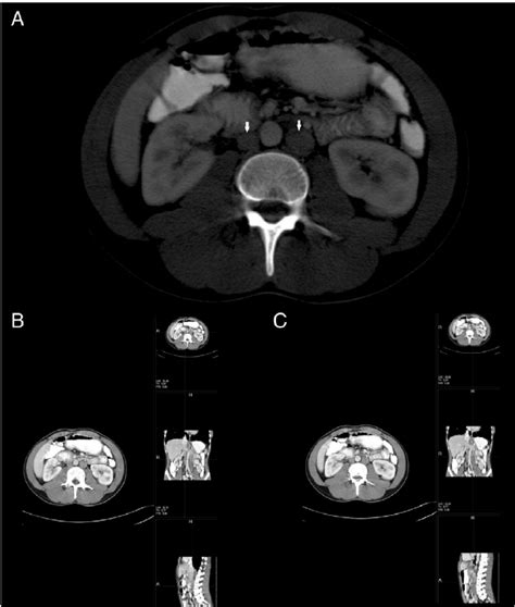 Axial Ct Image A Of A 29 Year Old Male Patient Demonstrates Double