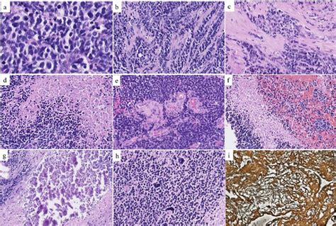 Histopathological Features A The Tumor Was Highly Cellular Composed