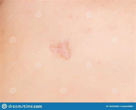 Inflamed Pimple On Nose Cyst Acne Acne On The Skin Royalty Free Stock