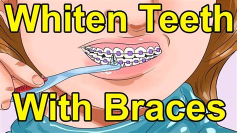 How To Whiten Teeth With Braces Tips To Learn How To Whiten Teeth