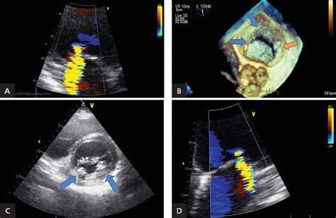 Figure From Percutaneous Direct Mitral Annuloplasty Using The