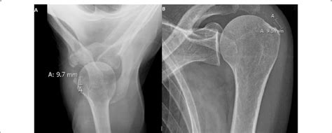 Anteroposterior Shoulder X Ray Performed At Baseline A And After 10 Download Scientific