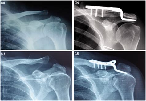 Fifteen Degree Clavicular Hook Plate Achieves Better Clinical Outcomes