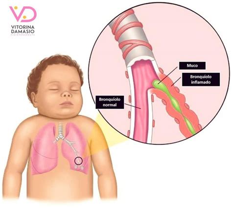 Bronquiolite O Que É Principais Sintomas E Como Prevenir Essa Mobile