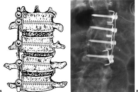 Spinal Instrumentation Radiology Key