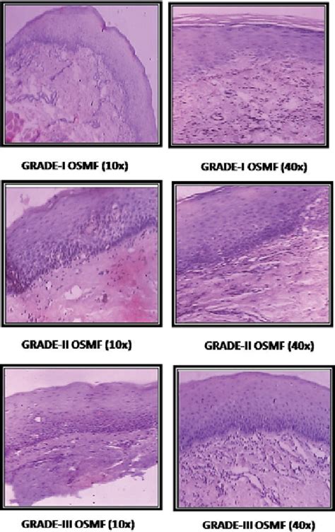 Oral Submucous Fibrosis Histopathology