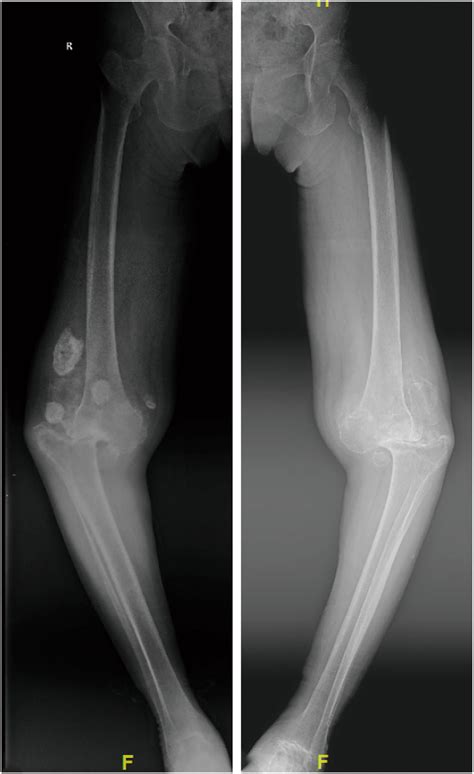 Preoperative Imaging Anteroposterior Weight Bearing Standing