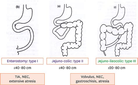 Short Bowel Syndrome As The Leading Cause Of Intestinal Failure In