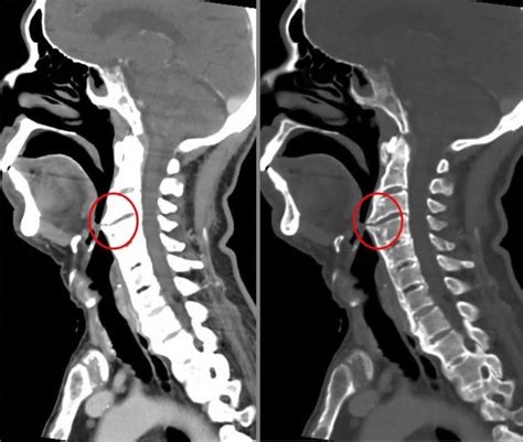 Diffuse Idiopathic Skeletal Hyperostosis Hyperostosis Frontalis