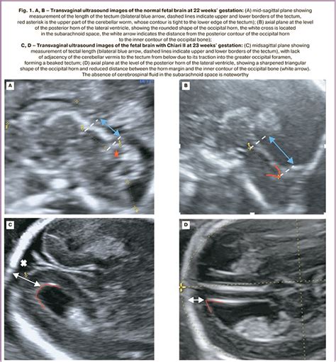 Arnold Chiari Malformation Ultrasound