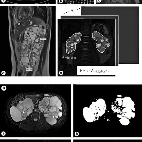 A Manual Techniques Available For Estimating Total Kidney Volume In