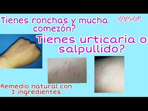 REMEDIO NATURAL PARA COMEZÓN Y RONCHAS YouTube