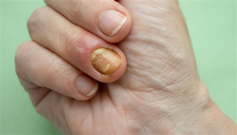Paronychia Disease Of The Fingernail Stock Photo Download Image Now