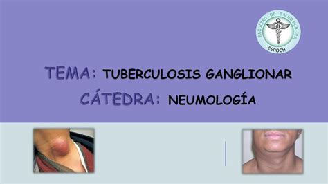 Tuberculosis Ganglionar Jordy Sam Udocz