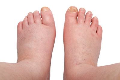 10 Causes For Swollen Feet Why Your Feet Ankles Legs Swell Lupon Gov Ph