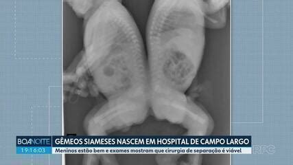 G Meos Nascem Unidos Por Pele E M Sculos Do Quadril No Paran Caso