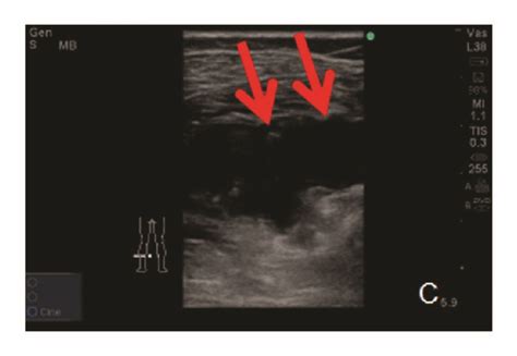 A F A Symptomatic Deep Vein Thrombosis Dvt Patient With Great Download Scientific Diagram