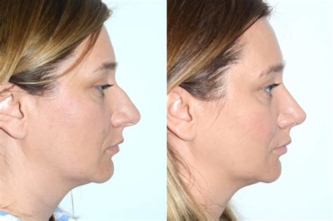 Rhinoplasty Miami Fl Nose Surgery Andres Bustillo Md Facs