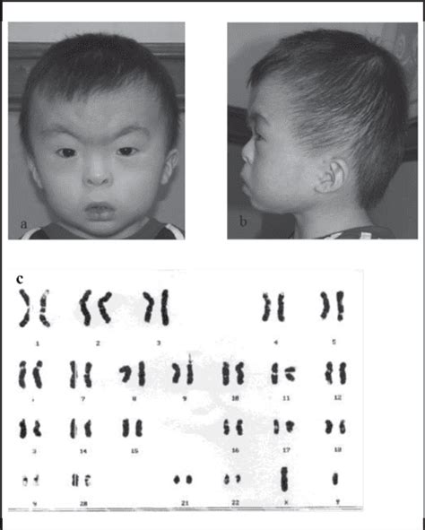 Pdf Partial Deletion 9p Syndrome In Malaysian Children Semantic