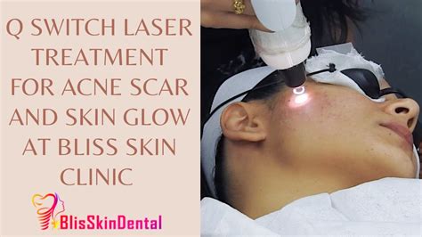 Q Switch Laser Treatment For Acne Scar And Skin Glow At Bliss Skin