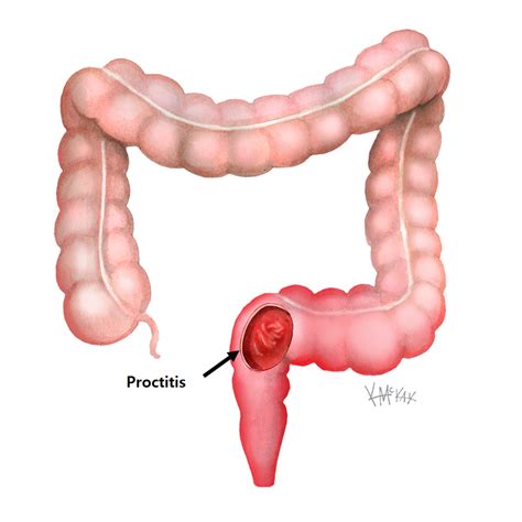 Proktitis Penyebab Gejala Diagnosis Dan Pengobatan