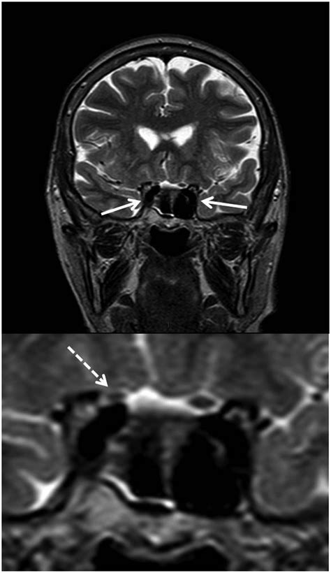 T2 Weighted Brain Magnetic Resonance Imaging Top Coronal View Shows