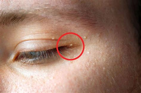 Filiform Warts What They Look Like Treatment And Causes 48 Off