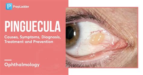 Pinguecula Causes Symptoms Diagnosis Treatment And Prevention