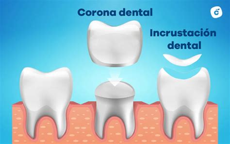 ¿qué Es Una Incrustación Dental Y Cuándo Se Realiza Cleardent