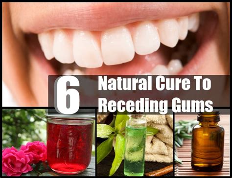 Natural Home Remedies For Receding Gums | Healthy Tips